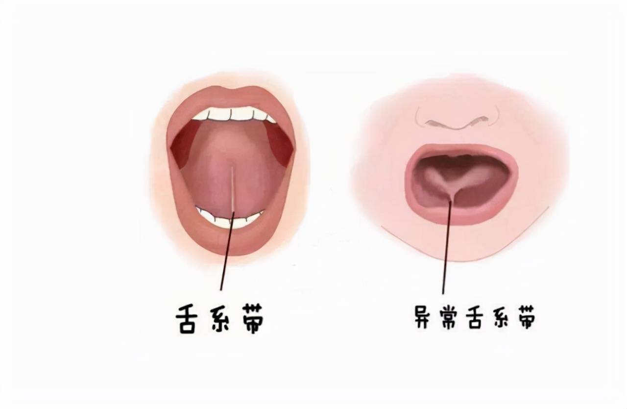 孩子舌系带短会影响他的说话吗？
