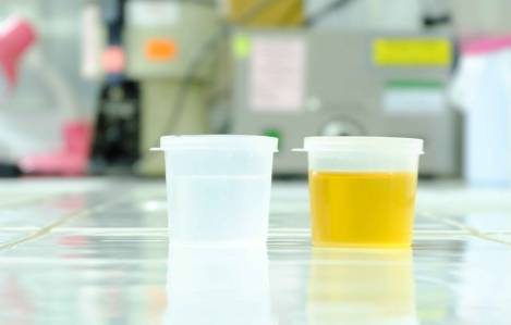 肾脏|早起上厕所，出现3种症状，可能尿酸“结晶”了，需注意肾衰竭