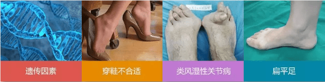 脚趾|上海健桥医院拇外翻侯明主任：拇外翻是—种病吗