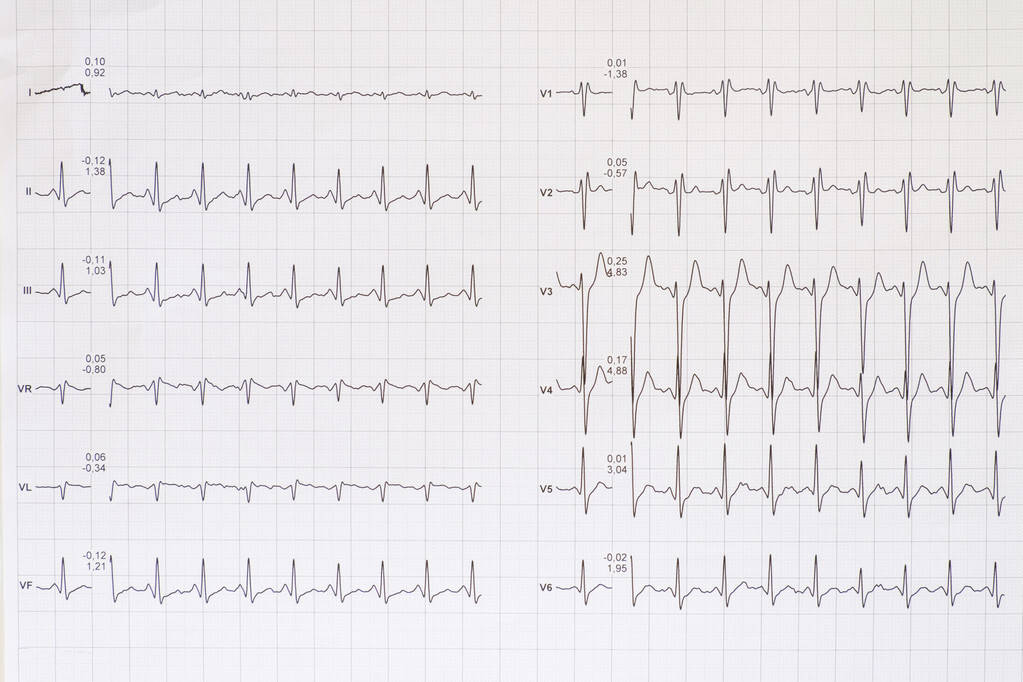 一,心脏早搏的多少,不能用一份心电图来判断:那么为什么频发早搏还不