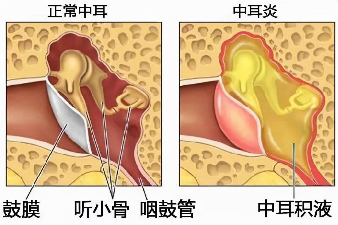 中耳炎不能拖听力损失还不是最严重的结果