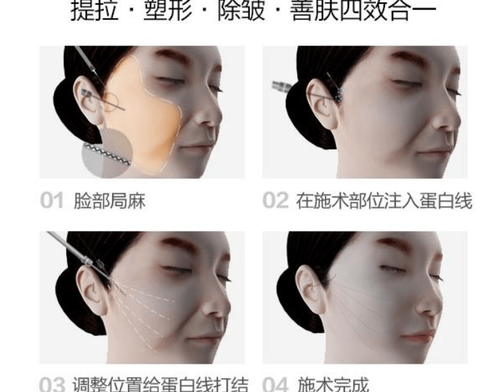 什么提线盾：鱼骨线和普通线雕有什么区别的回答让网友长知识~