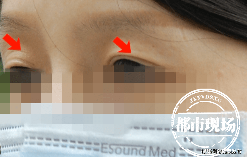女士女子在南昌“韩雅医疗美容”做眼综合手术 结果很失望