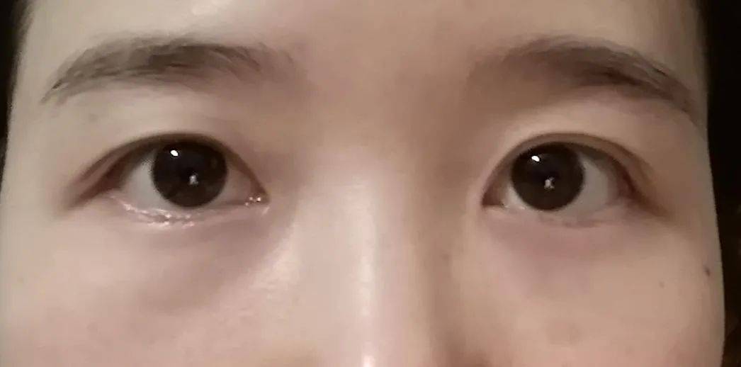 小逸提升变美不可兼得？和射频提升相比，传统拉皮手术对面部有哪些影响？