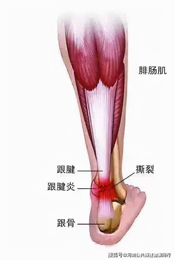 脚后跟韧带图图片