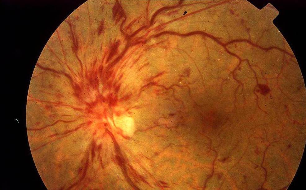 造影|高血压病人,除了肌酐升高,这些情况也说明你的肾功能变差了