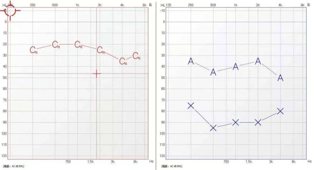 墊江惠耳聽力分享——佩戴人工耳蝸一年前vs一年後