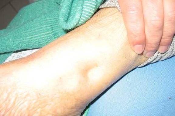 活动|这四类人肾脏很容易坏掉，警惕三种表现，做好三件事，肾会变好！