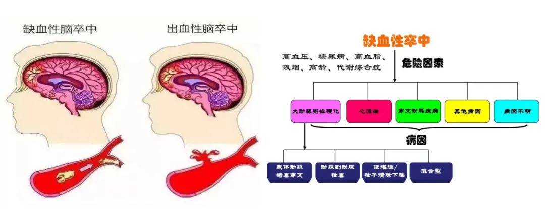 出血与出血性卒中三、我的中风是哪一类型？原因是什么？当确诊为中风后