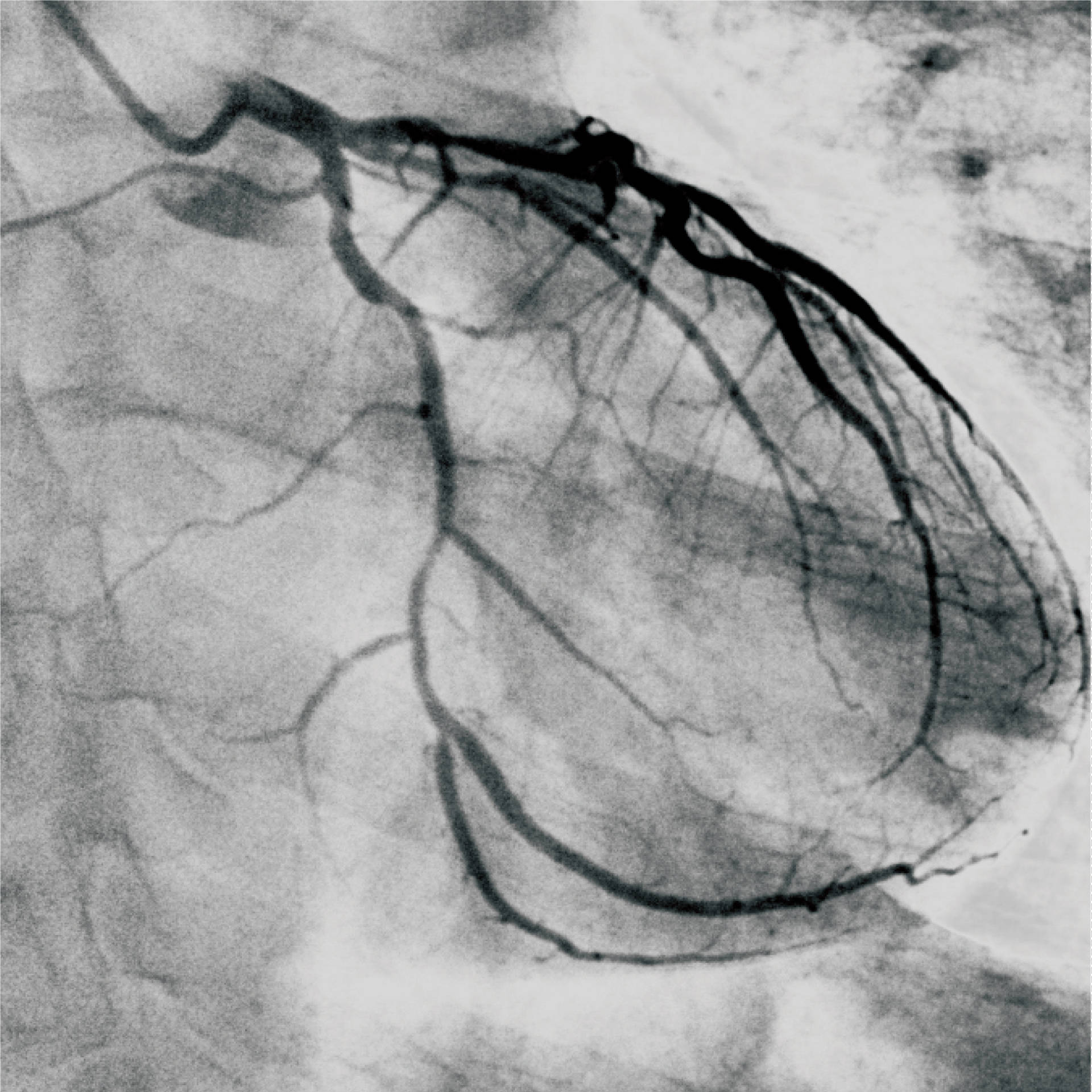什么是介入治疗?_血管性