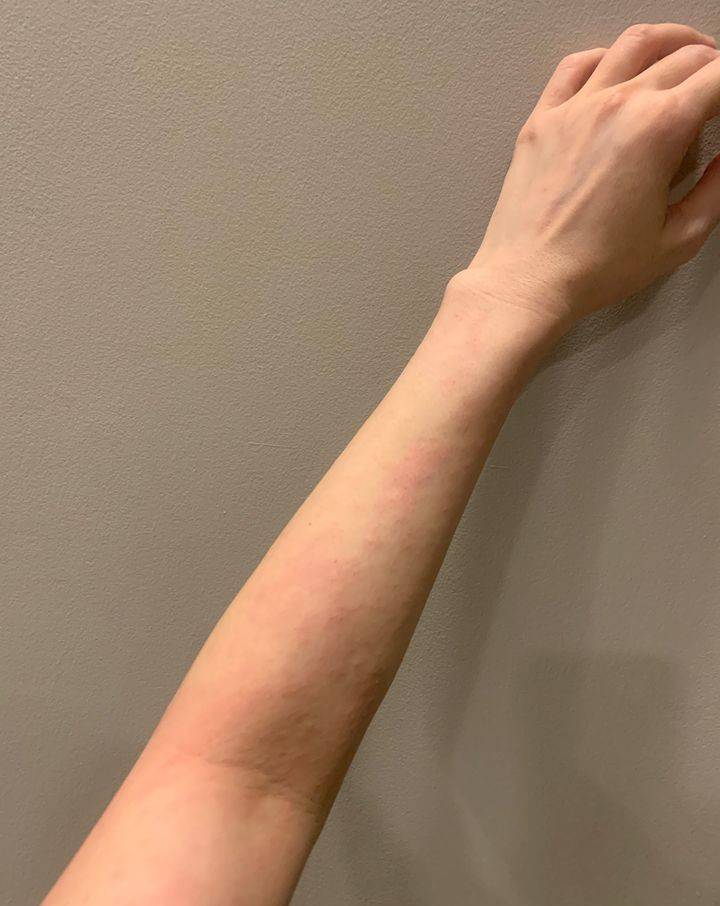 线状苔藓可以抹身体乳吗(线状苔藓可以抹身体乳吗图片) 线状苔藓可以抹身体乳吗(线状苔藓可以抹身体乳吗图片)