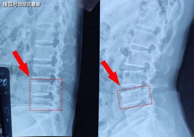 腰椎管狭窄是怎么引起的邱氏悬壶