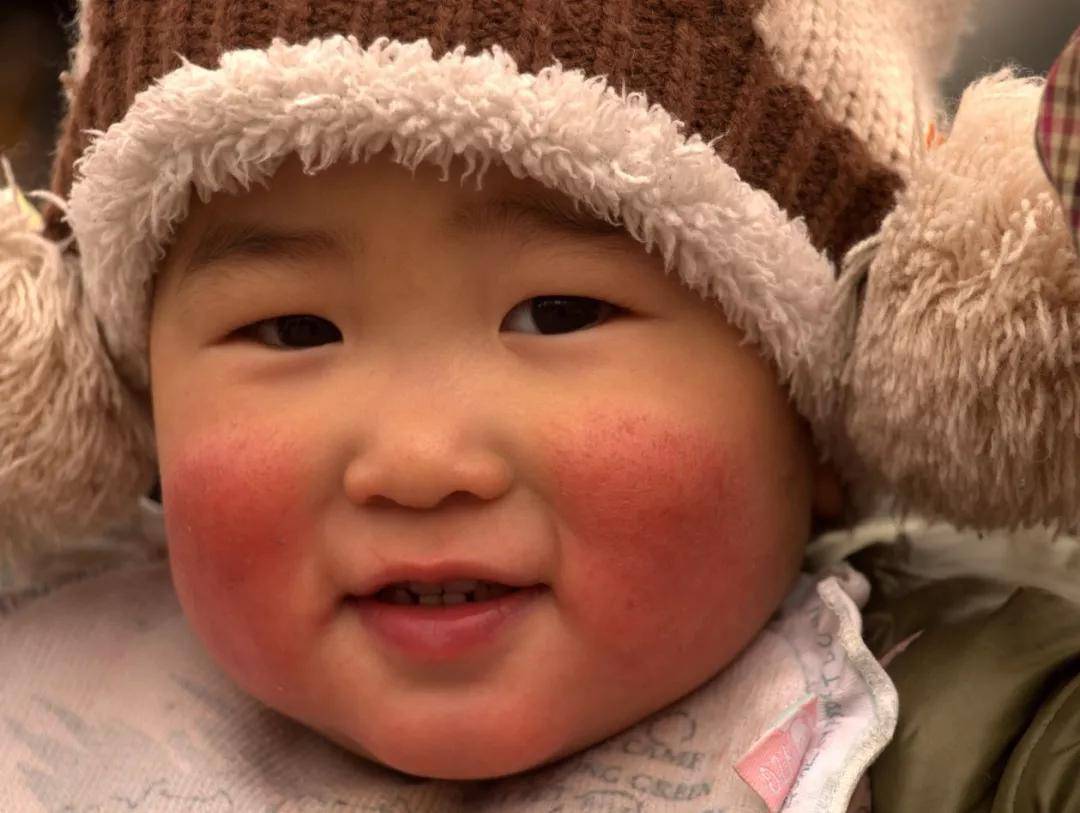 宝宝红脸蛋不是可爱,可能暗示这些健康问题!