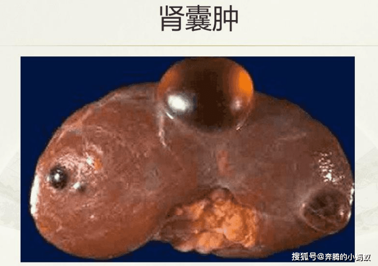 肾脏|肾囊肿是良性病，不是肿瘤！吃药就能消掉它！