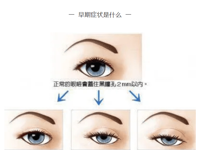 严重|卢老健康课堂:发现睁眼困难、眼睑下垂谨慎—眼肌型重症肌无力！