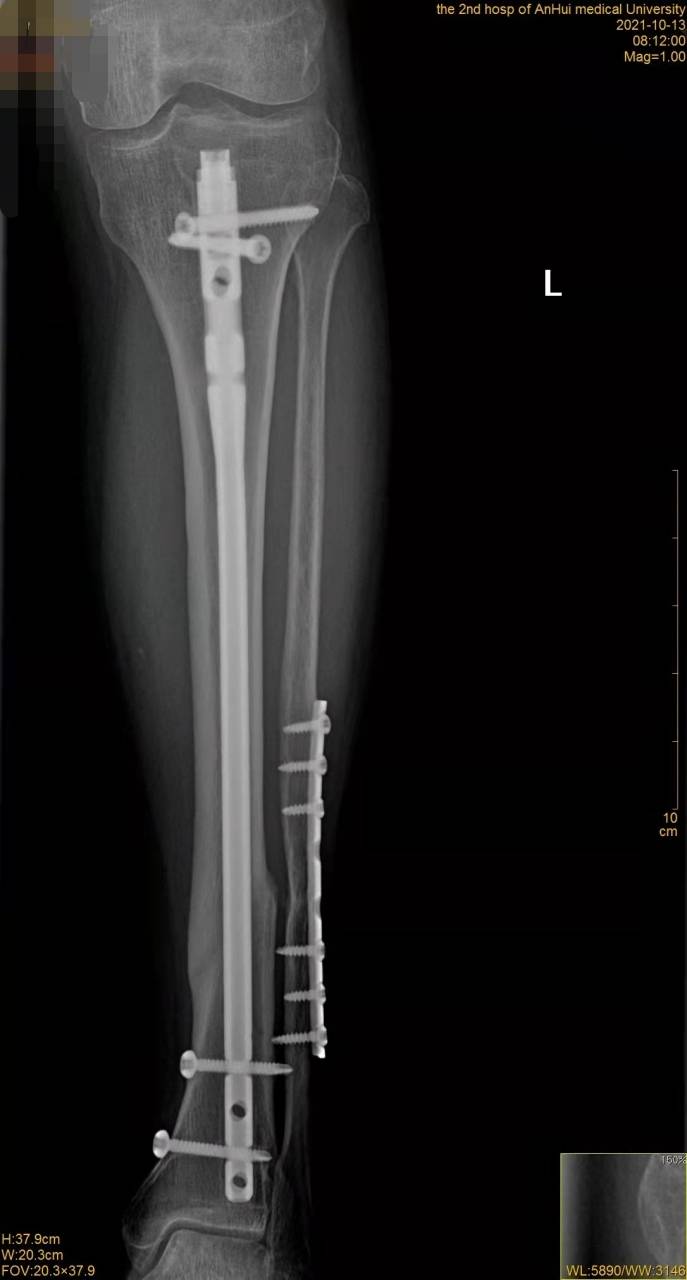 警惕 小腿骨折手术后 脚趾惊现 勒马缰畸形 疼得走不了 肌腱