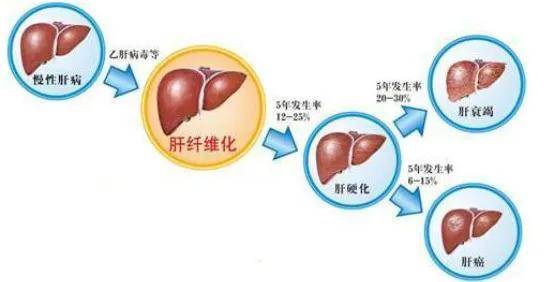 功能|患上肝纤维化，身体会出现哪些症状？