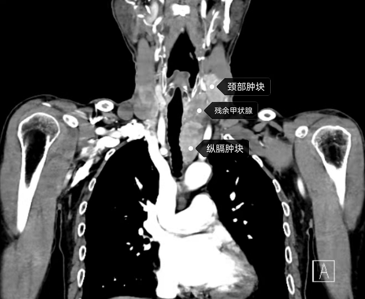 【影像檢查顯示:雙側甲狀腺殘餘腺體內多發腫塊並與氣管,食管分交不