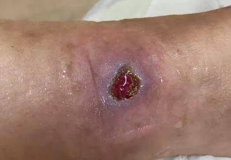 静脉曲张5大常见并发症_下肢_治疗_淤血