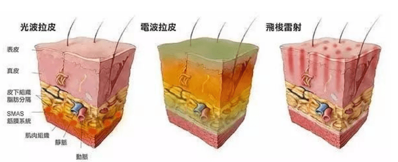 真皮大实话：热拉提多少钱做一次？热拉提多久做一次合适？