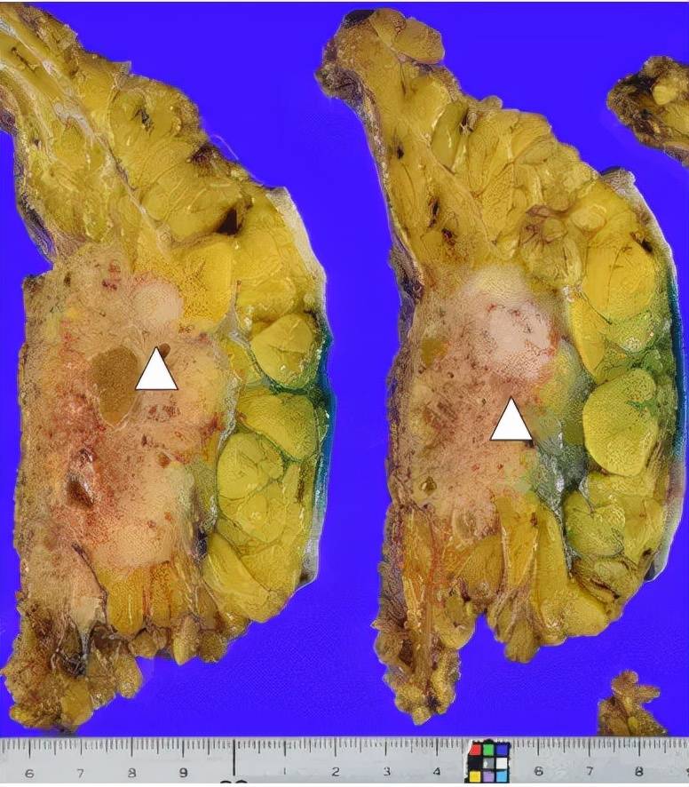 可见(白色箭头表示肿瘤),显示乳腺癌肿块病变的背侧有多个硅胶肉芽肿