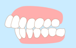 2,上排前牙靠上顎一側的牙齦或下排前牙靠著嘴唇一側的牙齦,會導致