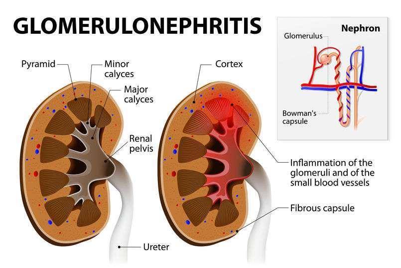 治疗|1258颗结石从体内取出，无症状？或是这3个症状，你而不自知