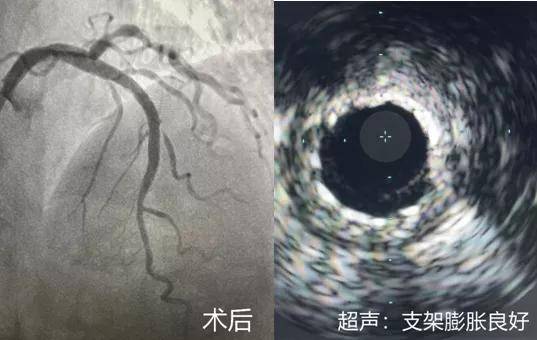 冠脉|冠脉内旋磨｜拿起“金刚钻”降服钙化保健康