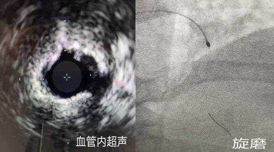 冠脉|冠脉内旋磨｜拿起“金刚钻”降服钙化保健康