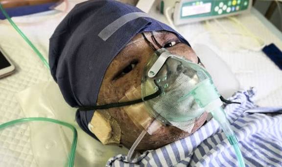 谢思明生于福建省安溪县,6岁被确诊为eb病毒引起的t淋巴细胞增生性