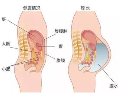 肝脏|肝腹水患者能治好吗？生存期是多久？