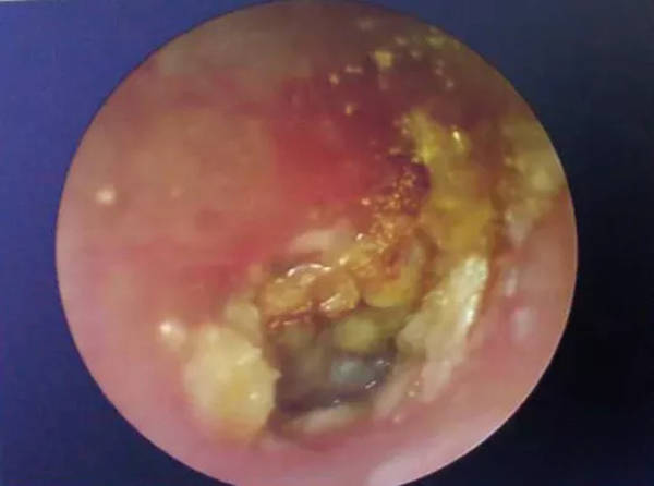 脂肪酸|掏耳朵导致耳朵发炎 来成都民生耳鼻喉医院就对了