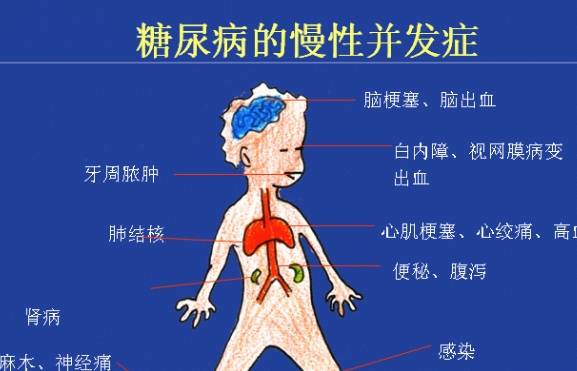 方法|糖尿病患者身体出现的4种症状，控制饮食方法，做到这5点降血糖！