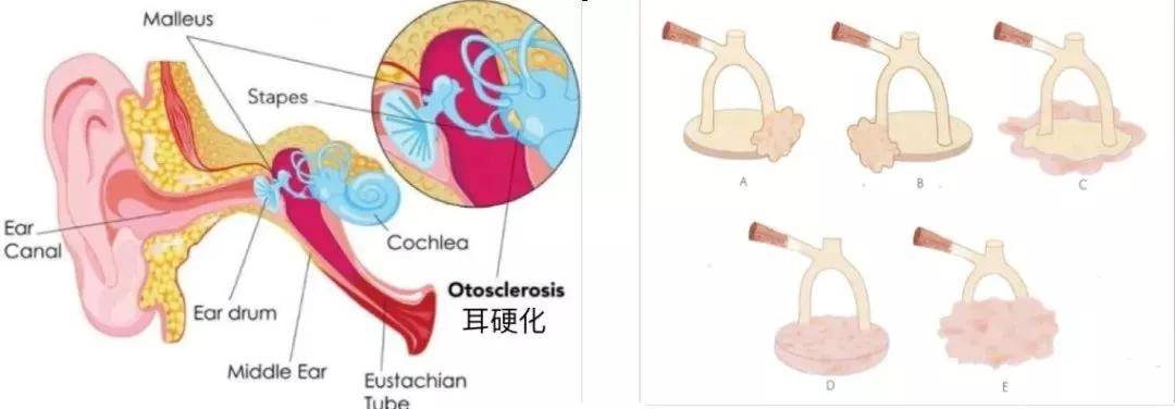 耳硬化症((otosclerosis)的發病原因不明,病理上是由於骨迷路原發性