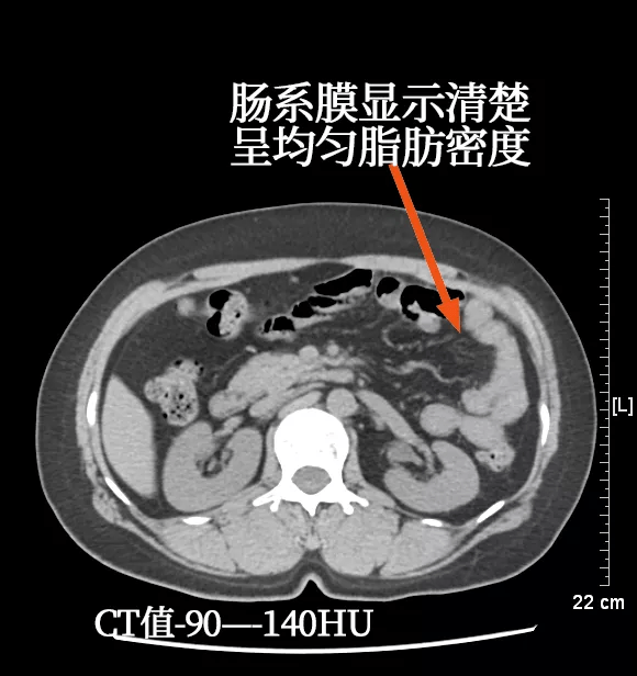 外傷患者如何看腸管掌握這些影像徵象就夠了