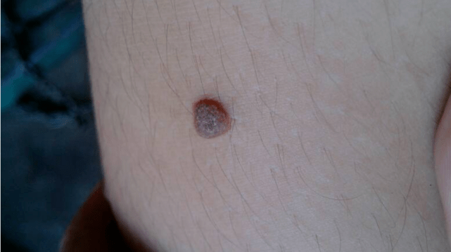 高危型hpv病毒长期感染导致,而有些病毒在接触身体时,会导致人体长疣