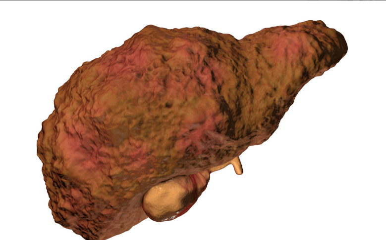 治疗|得了肝硬化还可以活多久?硬化的肝脏还能逆转吗?