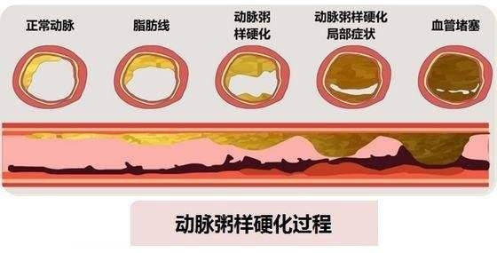 一,初期症状比较轻微,致使脚部稍微发凉,麻木;第二,随着血管继续变窄