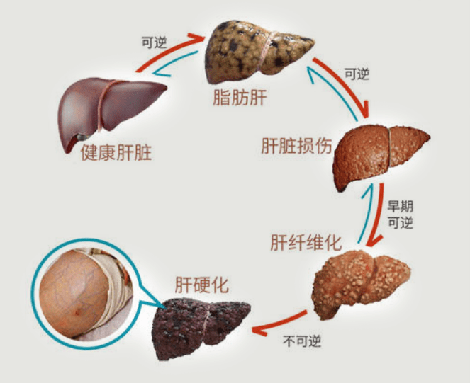 肝结石怎么引起的 来自搜狐网