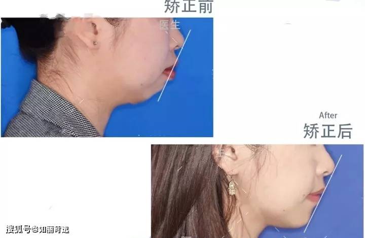 宋轶凸嘴无法修复的四种迹象,千万别中招