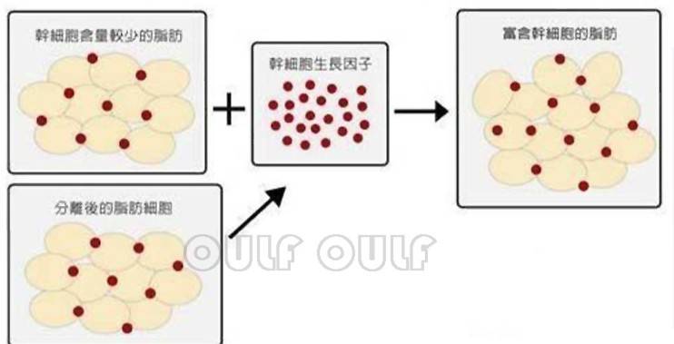 能量脂肪填充眼窝多久恢复自然？脂肪填充眼窝一年后图片惊呆了前男友~