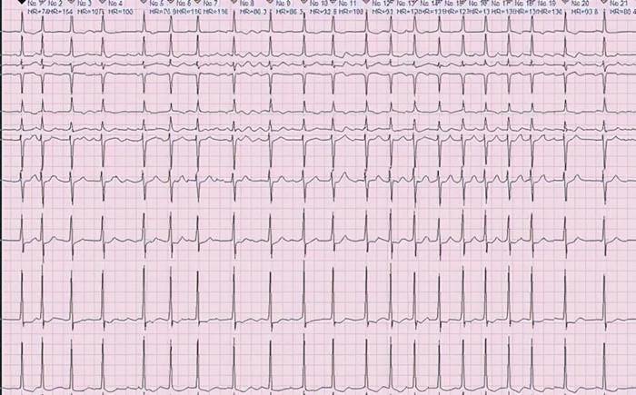 心脏|房颤不仅仅是心慌这么简单！房颤不治疗会导致脑梗死！