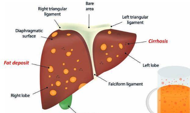 因为|肝不好的人，通常会有这4个共性，经常做肝脏会很受伤，赶紧纠正