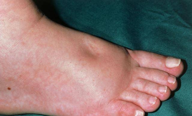 毒素|肝功能“稀烂”的人，身体会出现4个表现，占一个，都要及时检查