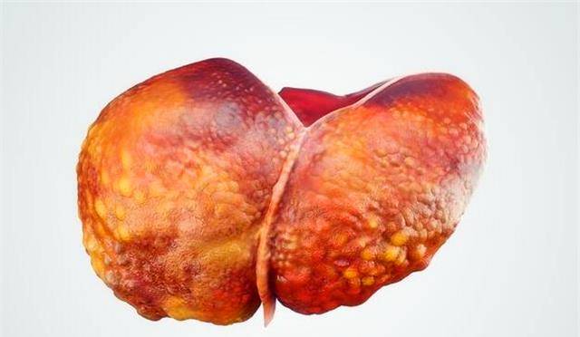 什么|肝脏不好，平时喝点酒，如何判断肝部到底是什么情况？看专家理解