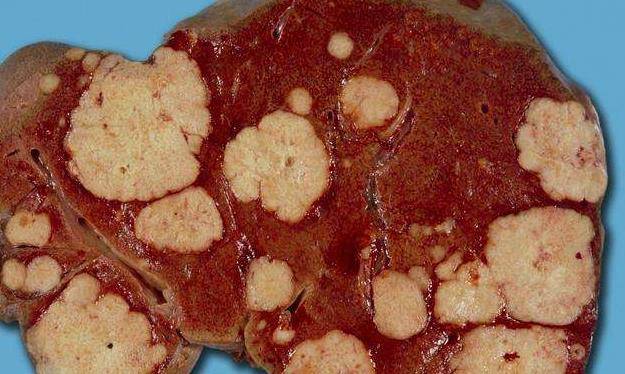 免疫力|肝脏有疾，双手先“知道”，如有3种“反常”，劝你早日养肝