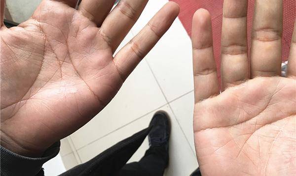 眼睛|肝脏好不好，手先知！肝脏出现问题，手上会有什么变化？