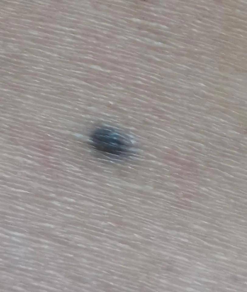 医美| 那些切过的痣,请温柔以待_心口_进行_其他