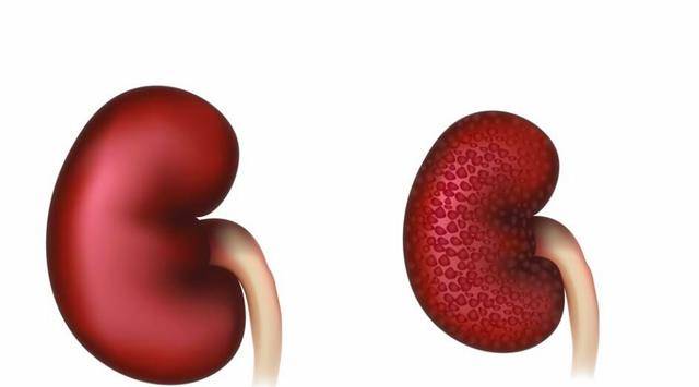 肾脏|高血压常与肾病“狼狈为奸”，如何预防高血压和肾病才会有效？