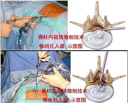 椎间孔镜和ube技术哪个更好